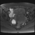 Adenomyosis and endometriotic cysts (Radiopaedia 82300-96367 Axial T1 fat sat 11).jpg