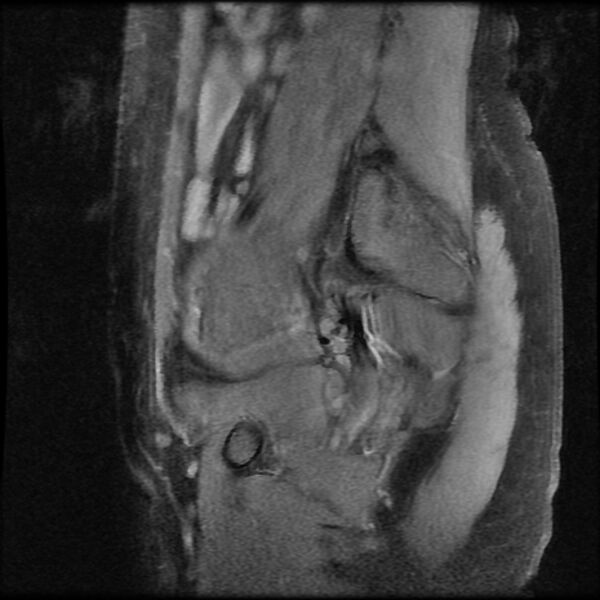 File:Adenomyosis on MRI (Radiopaedia 29328-29780 Sagittal T1 fat sat 2).jpg