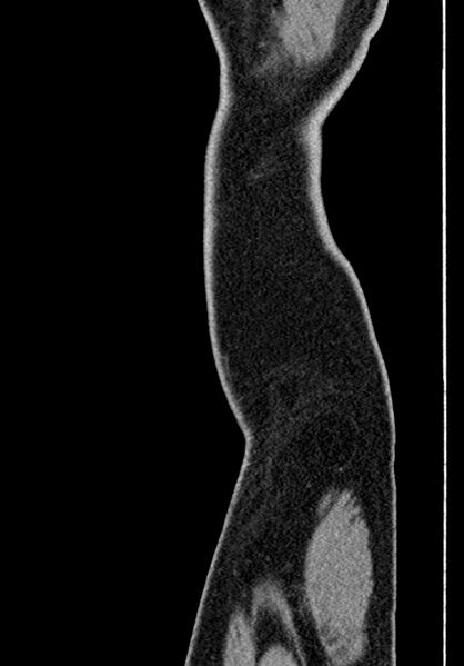 File:Adhesional small bowel obstruction (Radiopaedia 58900-66131 Sagittal C+ portal venous phase 250).jpg