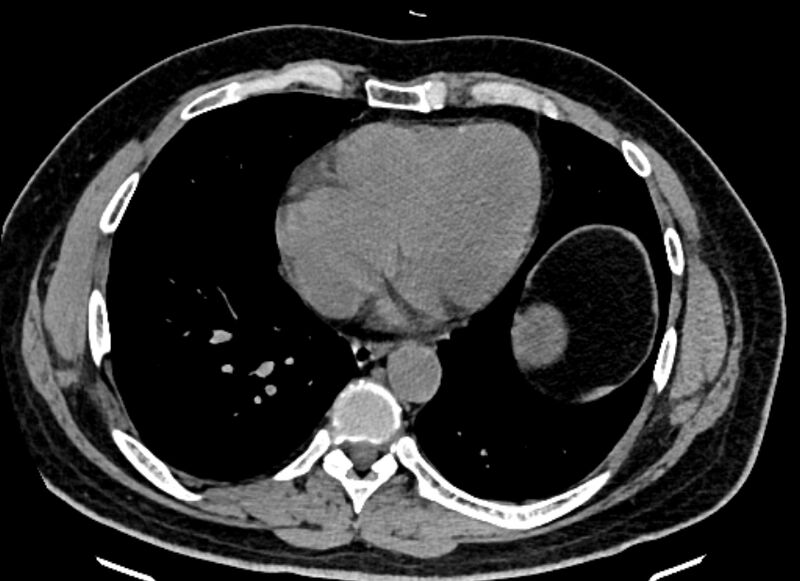 File:Adrenal metastases (Radiopaedia 73082-83791 Axial non-contrast 3).jpg
