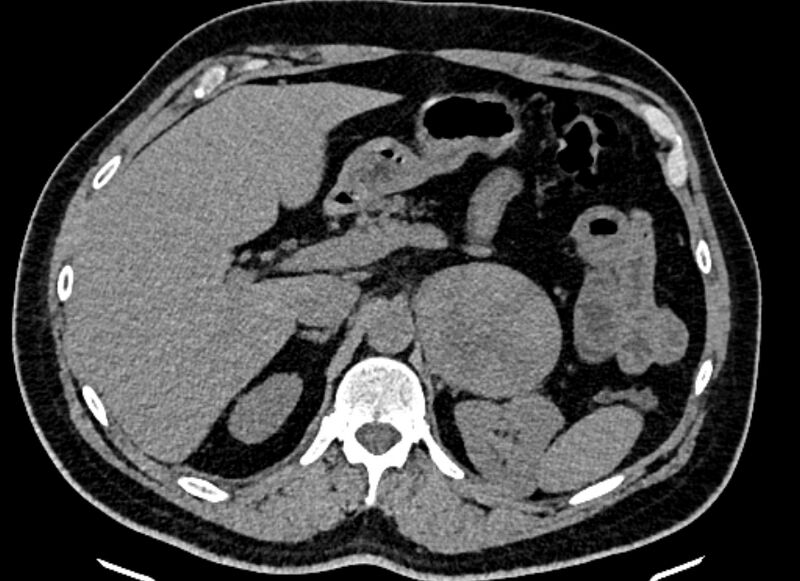 File:Adrenal metastases (Radiopaedia 73082-83791 Axial non-contrast 52).jpg