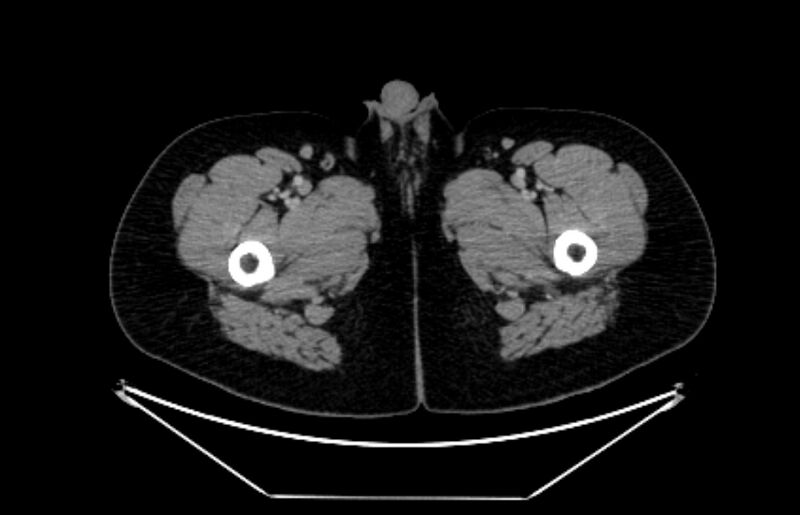 File:Adrenocortical carcinoma (Radiopaedia 80134-93438 Axial C+ portal venous phase 150).jpg