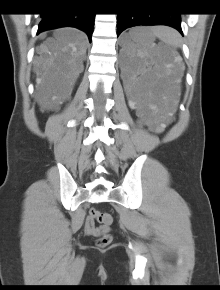 File:Adult polycystic kidney disease (Radiopaedia 47866-52626 Coronal non-contrast 39).png