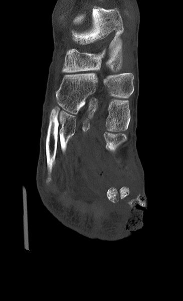 File:Advanced osteomyelitis due to open metatarsal fracture (Radiopaedia 83891-99095 Coronal bone window 12).jpg