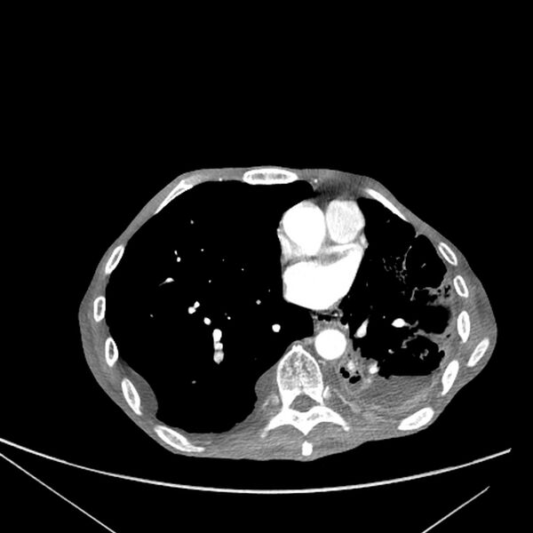 File:Advanced pulmonary tuberculosis (Radiopaedia 8599-9431 Axial liver window 12).jpg