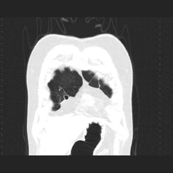 File:Allergic bronchopulmonary aspergillosis (Radiopaedia 21386-21320 Coronal lung window 2).jpg