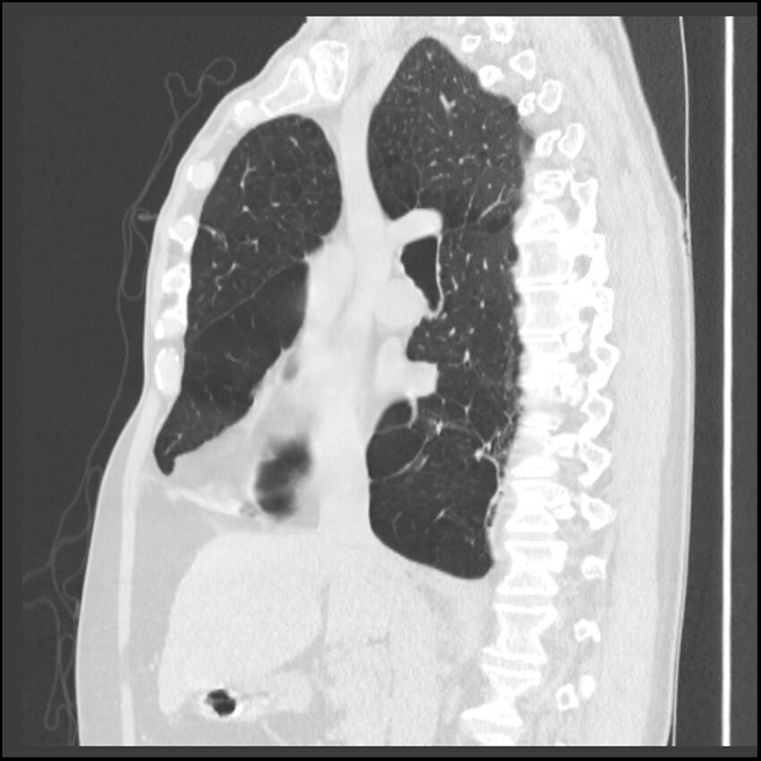 Alpha-1-antitrypsin deficiency (Radiopaedia 40993-43722 Sagittal lung window 151).jpg