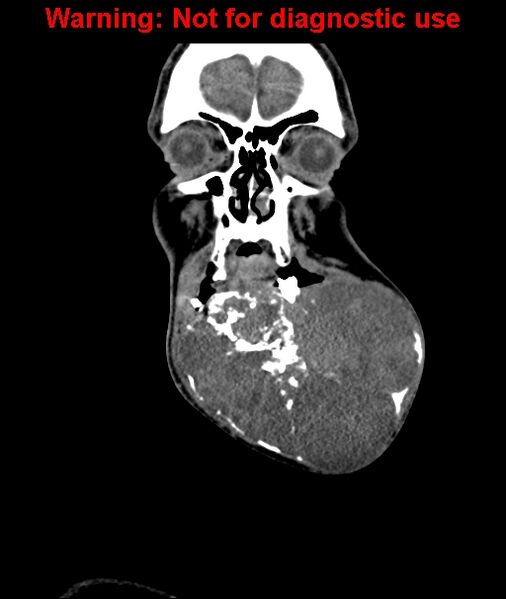 File:Ameloblastoma (Radiopaedia 33126-34164 D 16).jpg