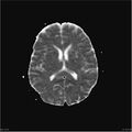 Amnestic syndrome secondary to hypoxic brain injury (Radiopaedia 24743-25004 ADC 18).jpg