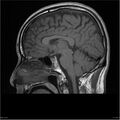 Amnestic syndrome secondary to hypoxic brain injury (Radiopaedia 24743-25004 T1 9).jpg