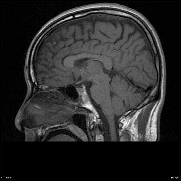 File:Amnestic syndrome secondary to hypoxic brain injury (Radiopaedia 24743-25004 T1 9).jpg