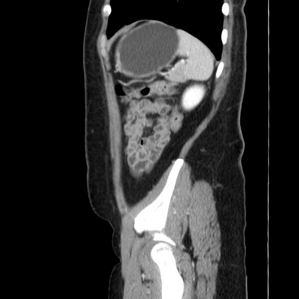 File:Ampullary tumor (Radiopaedia 22787-22816 D 46).jpg