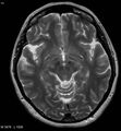 Amyotrophic lateral sclerosis (Radiopaedia 5373-7134 Axial T2 11).jpg