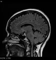 Amyotrophic lateral sclerosis (Radiopaedia 5373-7134 Sagittal FLAIR 10).jpg