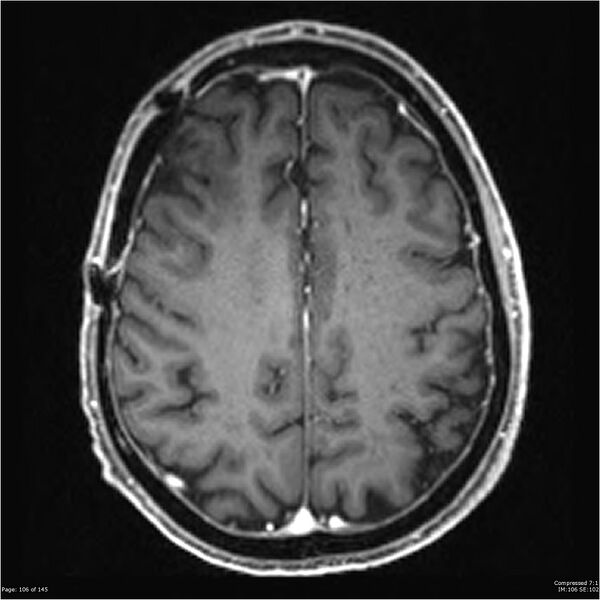 File:Anaplastic meningioma with recurrence (Radiopaedia 34452-35788 Axial T1 C+ 106).jpg