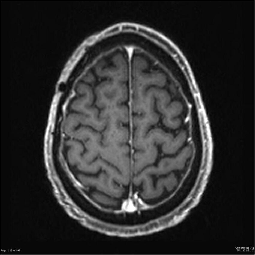 Anaplastic meningioma with recurrence (Radiopaedia 34452-35788 Axial T1 C+ 122).jpg