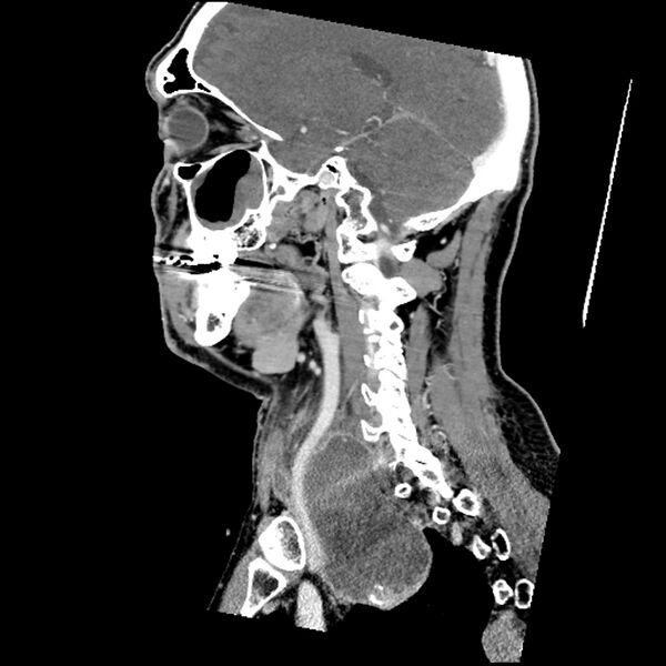 File:Anaplastic thyroid carcinoma (Radiopaedia 79087-92034 C 37).jpg