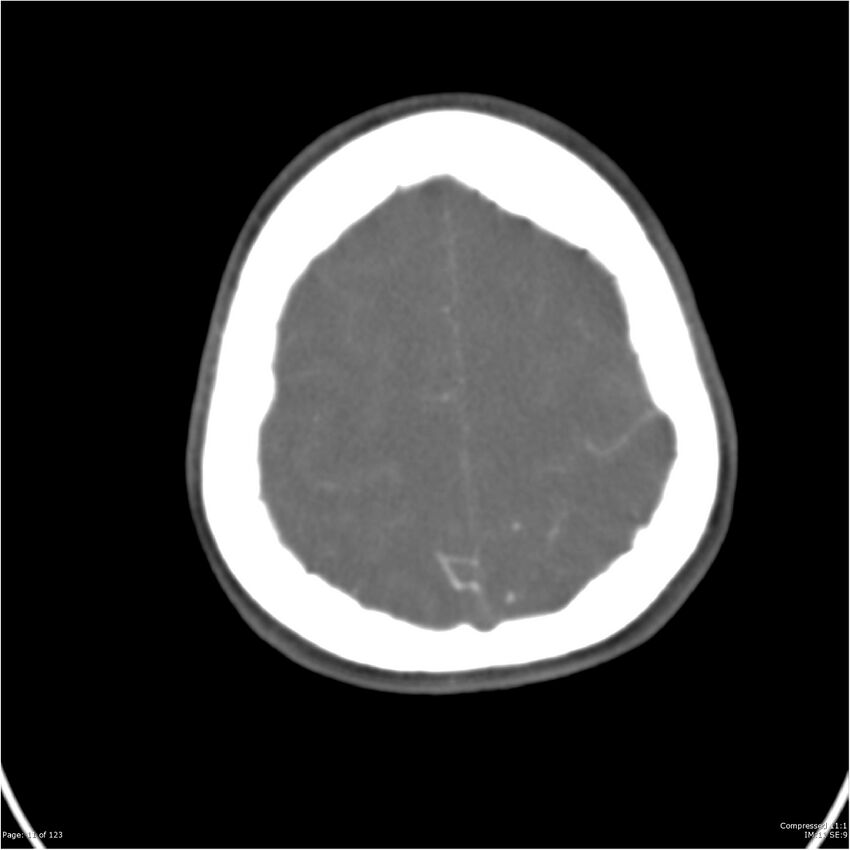 Aneurysmal subarachnoid hemorrhage and Moya Moya disease (Radiopaedia 34306-35593 Axial CT COW 11).jpg