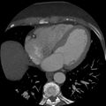 Anomalous origin of left circumflex artery from right coronary sinus (Radiopaedia 72563-83117 A 23).jpg