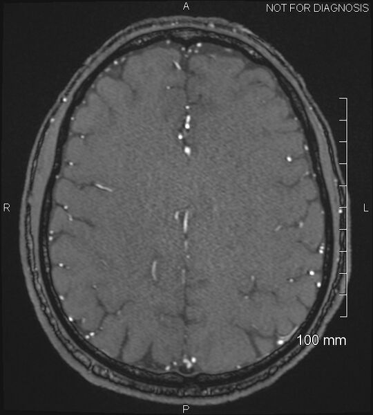 File:Anterior cerebral artery aneurysm (Radiopaedia 80683-94127 Axial MRA 172).jpg