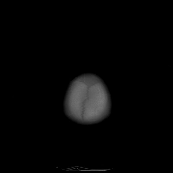 File:Anterior plagiocephaly (Radiopaedia 71836-82273 Axial bone window 21).jpg
