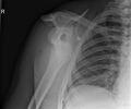 Anterior shoulder dislocation (Radiopaedia 18685).jpg