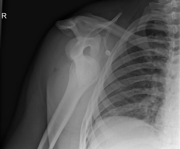 File:Anterior shoulder dislocation (Radiopaedia 18685).jpg