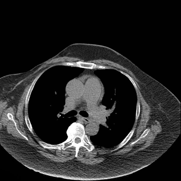 File:Aortic arch false aneurysm (Radiopaedia 14667-14587 Axial non-contrast 22).jpg