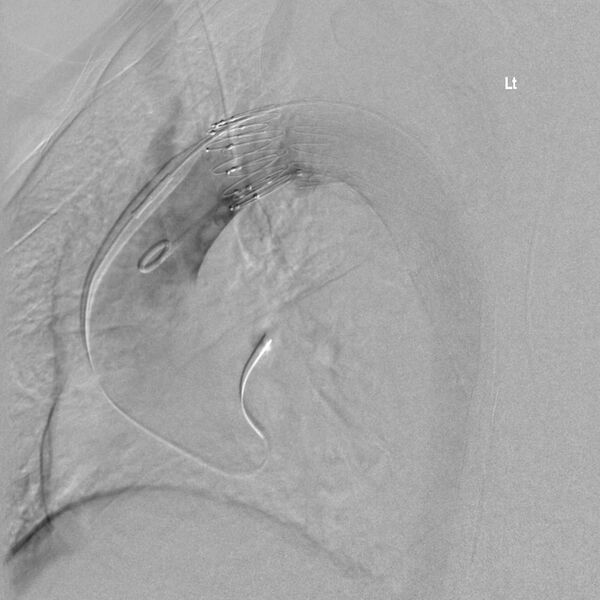 File:Aortic arch false aneurysm (Radiopaedia 14667-14589 Final result 8).jpg
