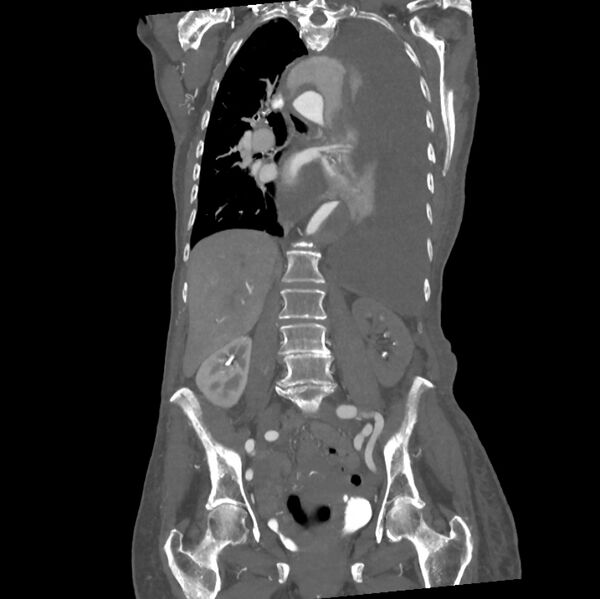 File:Aortic dissection (Radiopaedia 68763-78691 B 24).jpeg