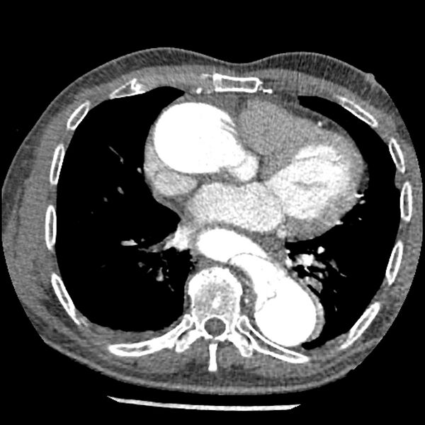 File:Aortic dissection - DeBakey Type I-Stanford A (Radiopaedia 79863-93115 A 23).jpg