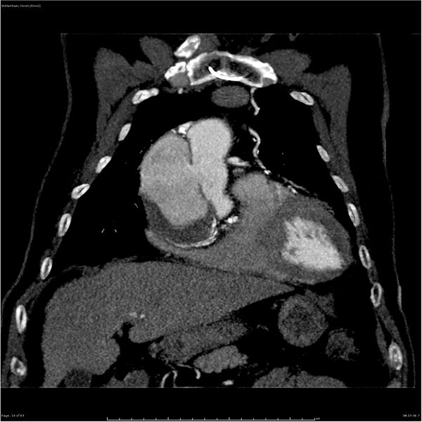 File:Aortic dissection - Stanford type A (Radiopaedia 26183-26315 A 10).jpg