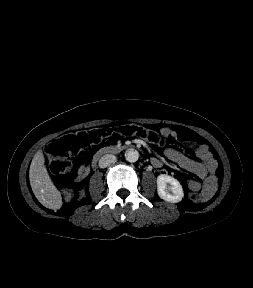 Aortic dissection with renal ischemia (Radiopaedia 76573-88338 B 42).jpg