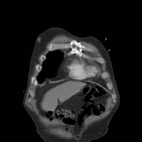 File:Aortic dissection with rupture into pericardium (Radiopaedia 12384-12647 B 1).jpg