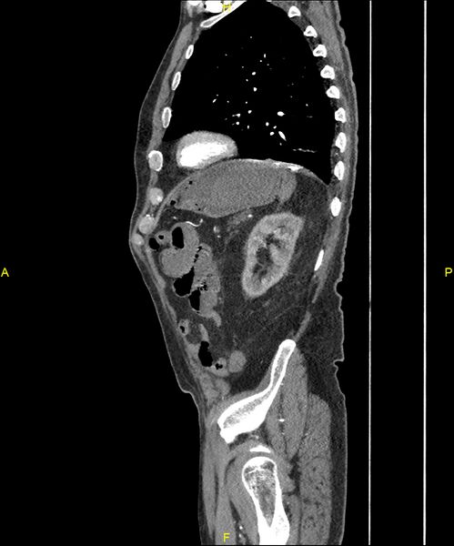File:Aortoenteric fistula (Radiopaedia 84308-99603 C 264).jpg
