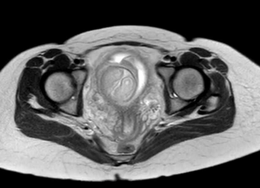 Appendicitis in gravida (MRI) (Radiopaedia 89433-106395 Axial T2 65).jpg