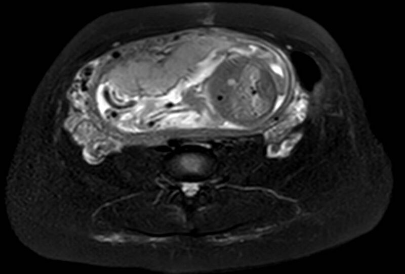 File:Appendicitis in gravida (MRI) (Radiopaedia 89433-106395 Axial T2 SPAIR 48).jpg