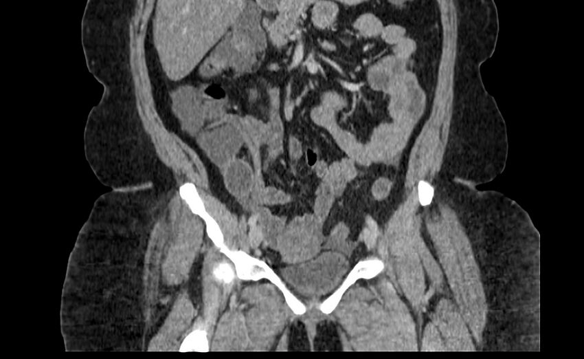 Appendix mucocele (Radiopaedia 41222-44033 B 31).jpg