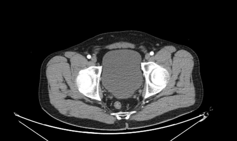 File:Arterial occlusive mesenteric ischemia (Radiopaedia 84641-100060 A 121).jpg