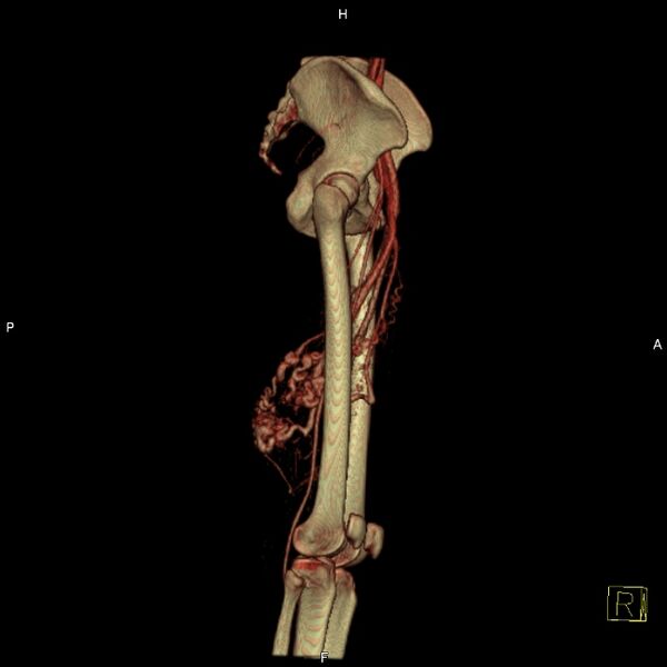 File:Arteriovenous malformation - thigh (Radiopaedia 14948-14883 3D reformat 7).jpg