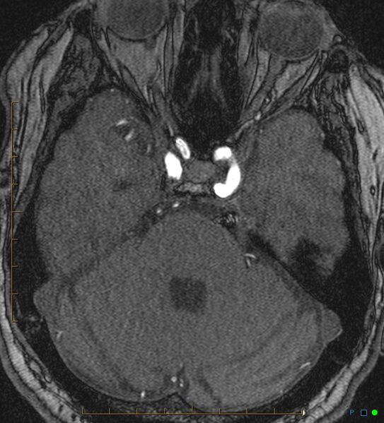 File:Artifactual basilar artery stenosis due to metallic stent (Radiopaedia 31206-31922 Axial MRA 10).jpg