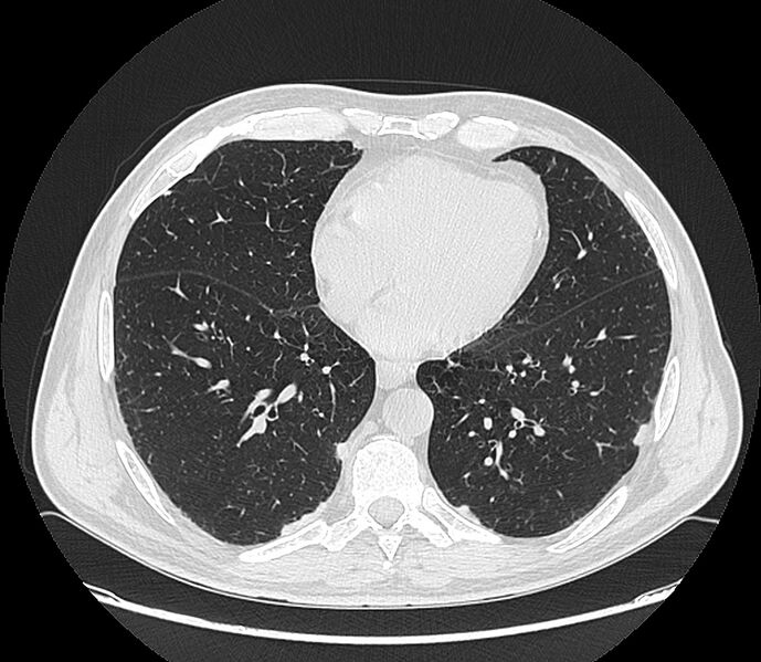 File:Asbestos pleural placques (Radiopaedia 57905-64872 Axial lung window 161).jpg