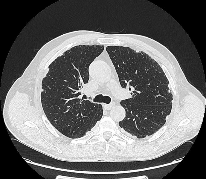File:Asbestos pleural placques (Radiopaedia 57905-64872 Axial lung window 97).jpg