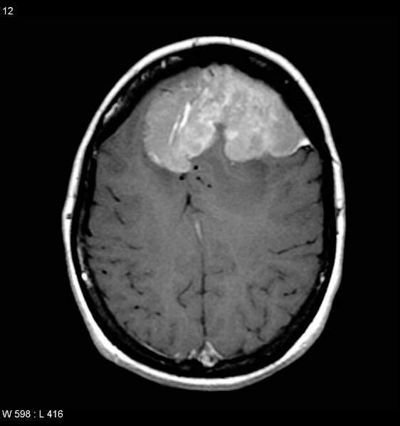 File:Atypical meningioma (WHO grade II) (Radiopaedia 7762-8586 D 8).jpg