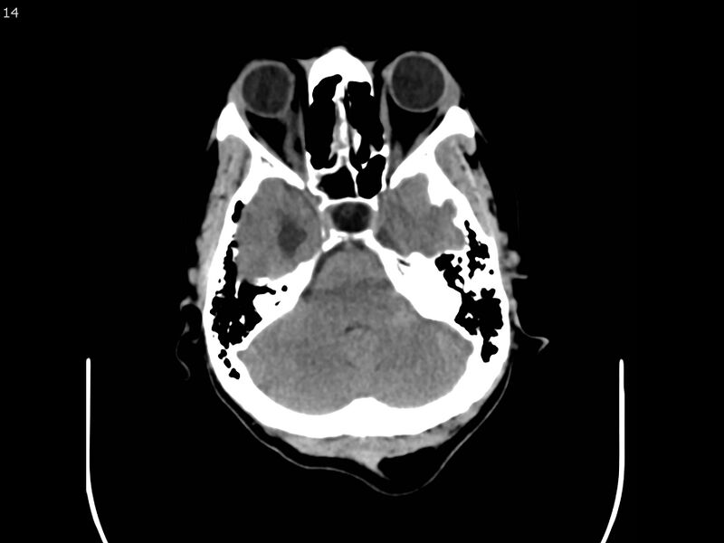 File:Atypical meningioma - intraosseous (Radiopaedia 64915-73867 A 14).jpg