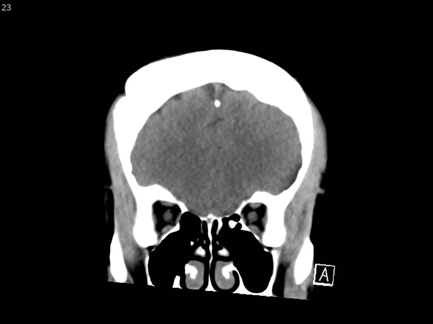 Atypical meningioma - intraosseous (Radiopaedia 64915-73867 B 22).jpg