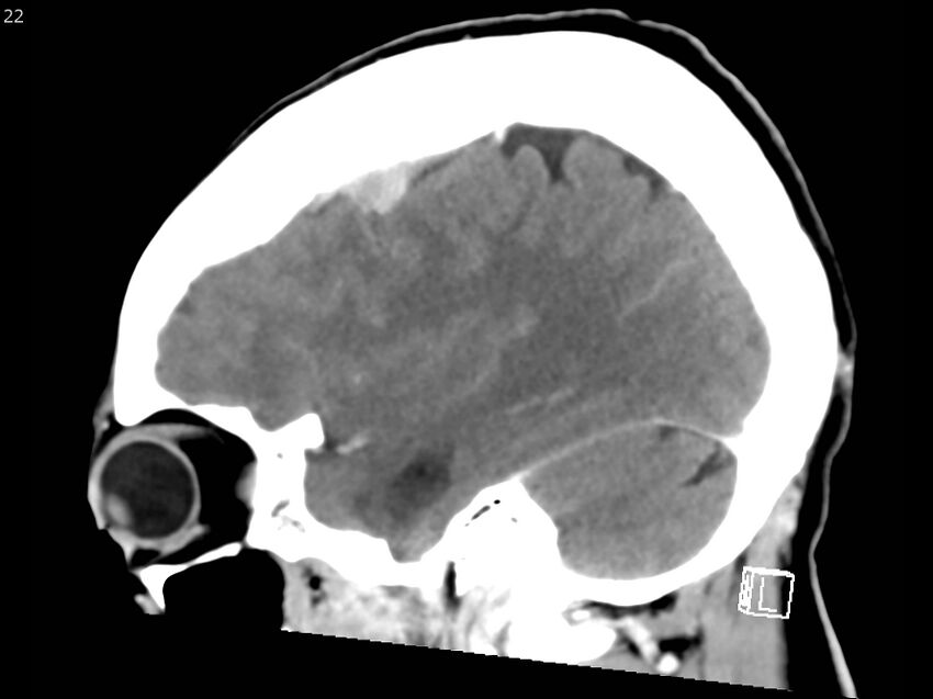 Atypical meningioma - intraosseous (Radiopaedia 64915-73867 F 21).jpg