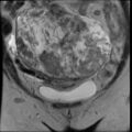 Atypical retroperitoneal lymphocoeles with large leiomyoma of uterus (Radiopaedia 32084-33027 Coronal T2 9).jpg