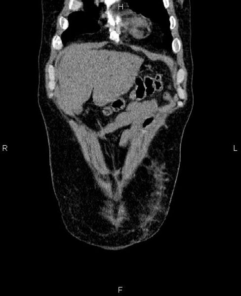 File:Autosomal dominant polycystic kidney disease (Radiopaedia 87830-104287 Coronal non-contrast 2).jpg