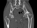 Avascular necrosis of the left hip (Radiopaedia 75068-86125 Coronal bone window 48).jpg